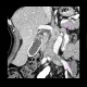 Porcelain gall bladder: CT - Computed tomography